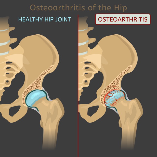 Hip osteoarthritis. Synovial joints degenerative disease.