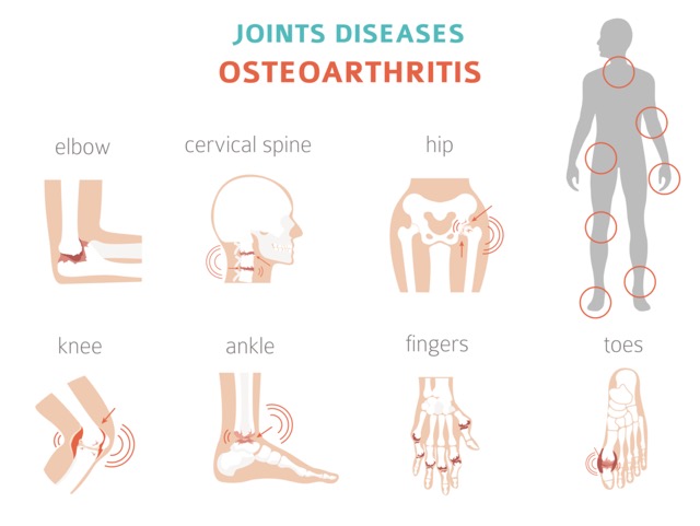 Arthritis, osteoarthritis medical infographic design. Joint replacement, implantant.