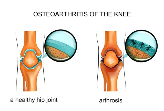 Vector illustration of osteoarthritis of the knee.