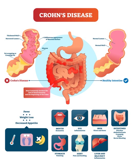 Crohns disease vector illustration. Labeled diagram with diagnosis and symptoms. Infographic with disorder and healthy intestine. Structure with gastrointestinal tract.